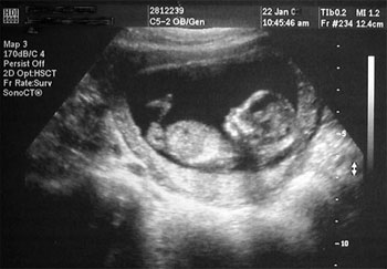 An ultrasound of a 12 week old iunborn baby